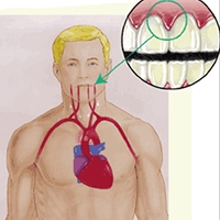 Implanturi dentare